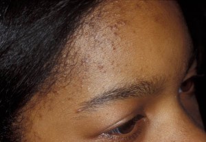 Painful blister-like bumps just above hairline back of ...