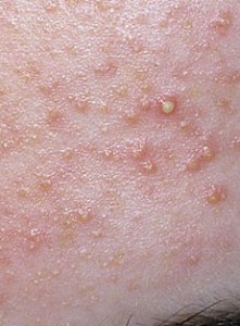 how can i get rid of acne