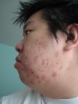 Adult acne