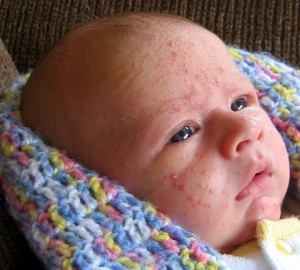 Infantile acne