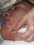 Corticosteroid Injection into acne lesion