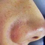 blackheads on nose