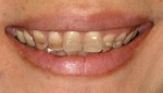 tetracycline stained teeth