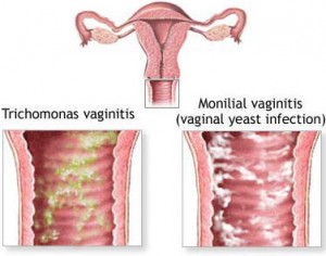 vaginitis