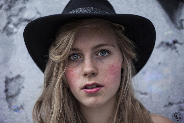 Woman with Rosacea