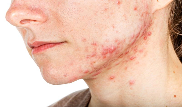 face with acne vulgaris