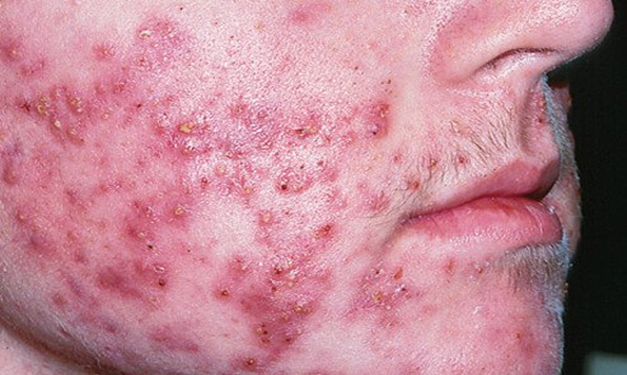 face with cystic acne