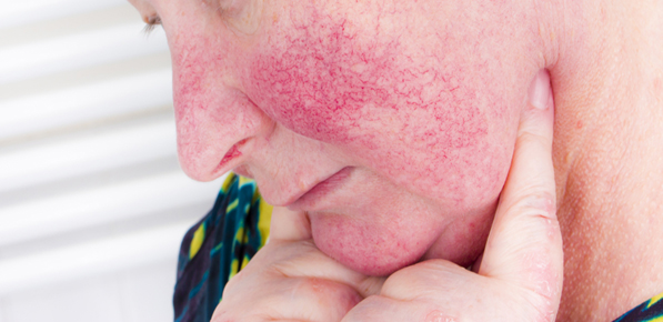 woman with rosacea